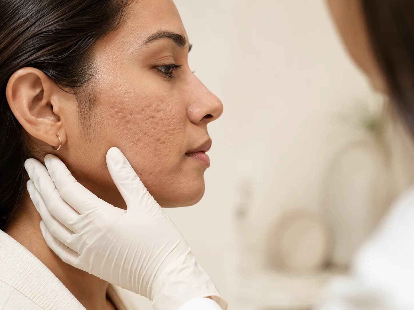 Fig. 01 Acne Scar Treatment